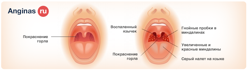 Что делать если болит горло.в домашних условиях Что делать если болит горло.в домашних условиях